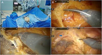 Surgical Outcomes of Robotic Resection for Sigmoid and Rectal Cancer: Analysis of 109 Patients From a Single Center in China